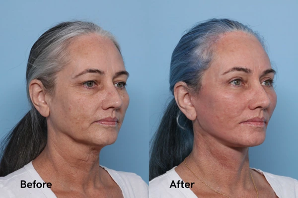 Before and after deep plane facelift showing natural jawline and neck contour