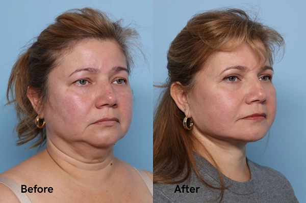 Before and after facelift result with natural facial rejuvenation
