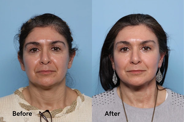 Before and after facelift result showing neck and jawline refinement
