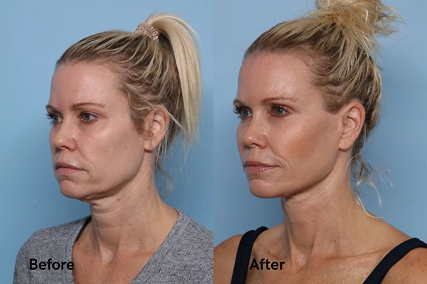 Before and after facelift result showing cheek and jawline lift